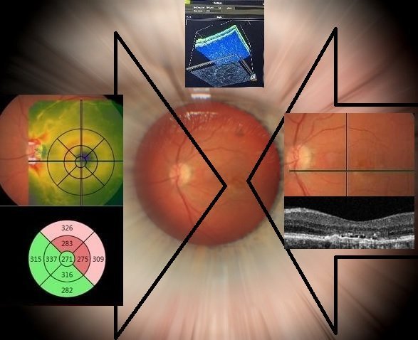 macular degeneraion location