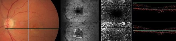 octa scan