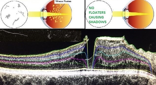 vitreous floaters