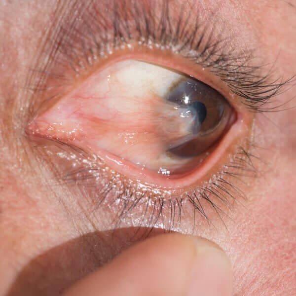 pterygium